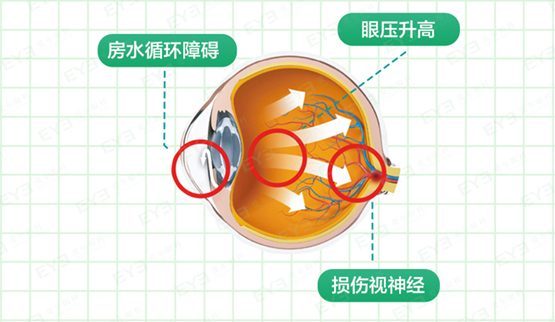 <b>得了青光眼，这些日常护理建议收藏！</b>